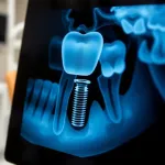 Odrzucenie implantu zęba: jak je rozpoznać i co robić?